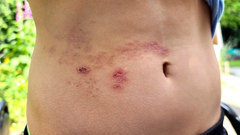 Abklingende Gürtelrose am Bauch: Bei der Gürtelrose hat man Schmerzen, Pusteln und Rötungen an einem Hautbereich. Oft ist ein gürtelförmiger Bereich am Oberkörper betroffen, daher der Name. Und das auch nur auf einer Seite des Körpers. Warum eigentlich?