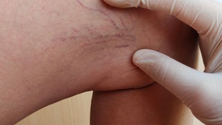 Hand im Gummihandschuh zeigt auf Bein mit Krampfadern und Besenreisern. Wie kann man vorbeugen, was sind Behandlungsmöglichkeiten abseits von Stripping?