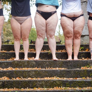 Fünf Frauen, die an Lipödem erkrankt sind stehen nebeneinander.