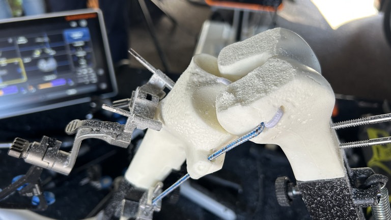 Ziel: schnell wieder laufen können! Dank der millimetergenauen Fräse ist alles so vorbereitet, dass das neue künstliche Kniegelenk perfekt passt. 
