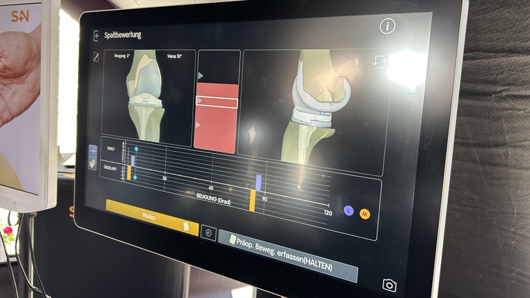 Jede Erhebung im Knie, jeder Unwucht, jede Kerbe wird von der Technik erkannt und in ein 3D-Modell am Computer verwandelt. 