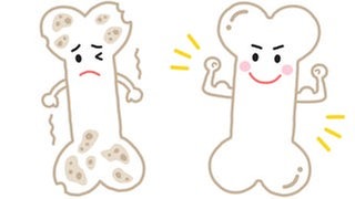 Osteoporose (Illustration): kranker "trauriger" Knochen und gesunder "fröhlicher" Knochen: Osteoporose betrifft in Deutschland rund 5,7 Millionen Menschen, vor allem Frauen nach der Menopause. Aber auch Männer kann es treffen. 