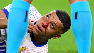 Der Franzose Kylian Mbappé erlitt bei der EM 2024 im Spiel gegen Österreich einen Nasenbeinbruch, nachdem er mit Kevin Danso kollidiert war: Hochleistungssportler haben ein 20-fach höheres Risiko sich zu verletzen als andere Sportler. 
