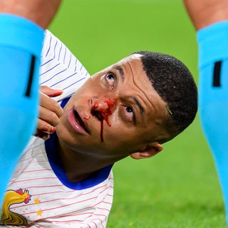 Der Franzose Kylian Mbappé erlitt bei der EM 2024 im Spiel gegen Österreich einen Nasenbeinbruch, nachdem er mit Kevin Danso kollidiert war: Hochleistungssportler haben ein 20-fach höheres Risiko sich zu verletzen als andere Sportler. 