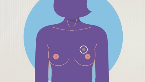 Piktogramm einer Frau mit einem Tumor in der Brust.